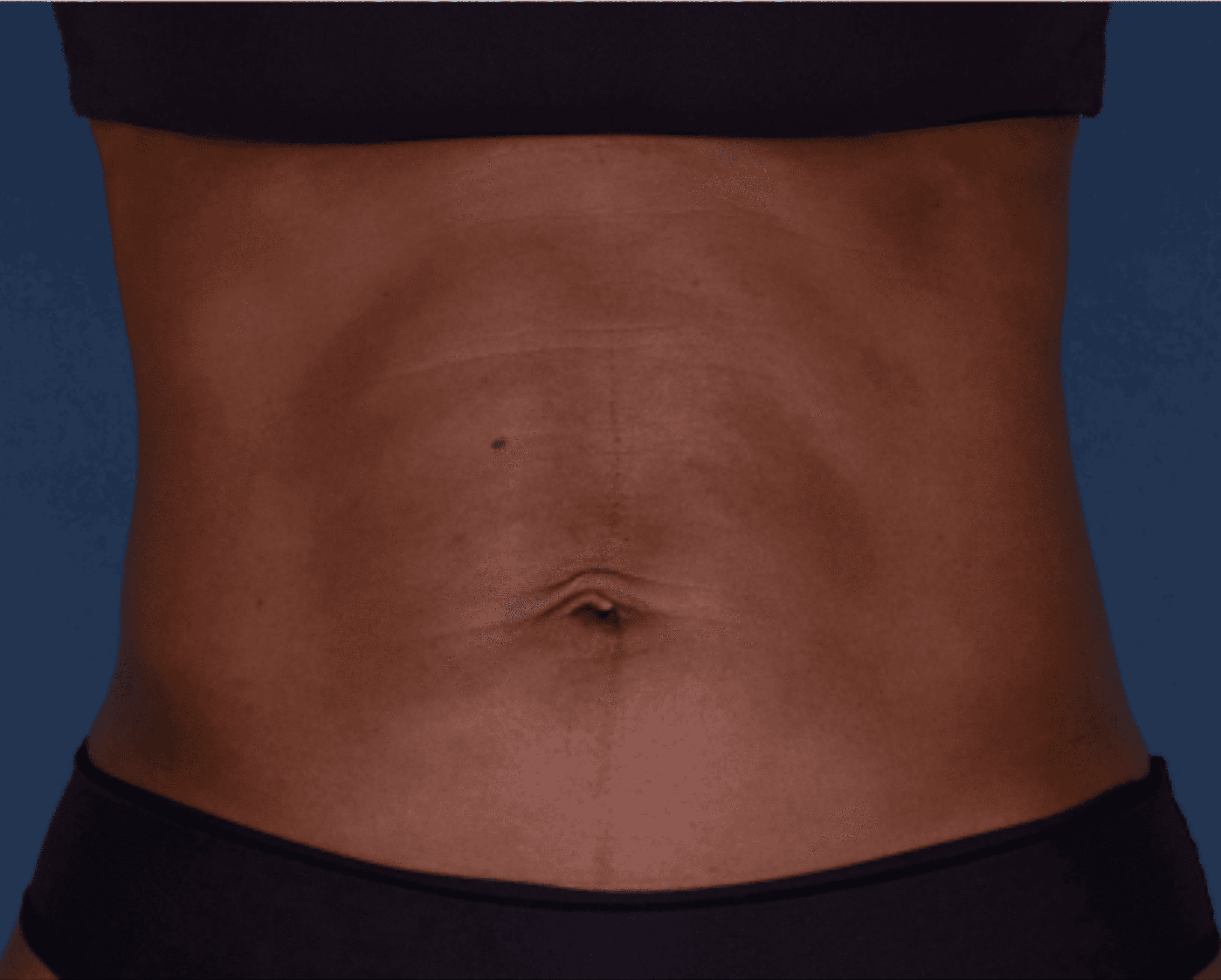 Quick. Non-Surgical. Minimal Downtime.